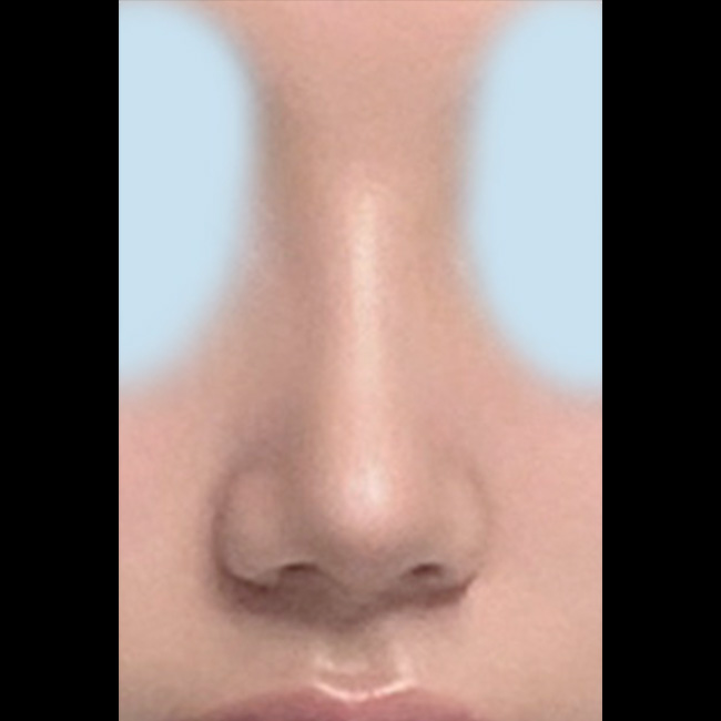 친구도 같이 했는데 둘다 코성형 성공!