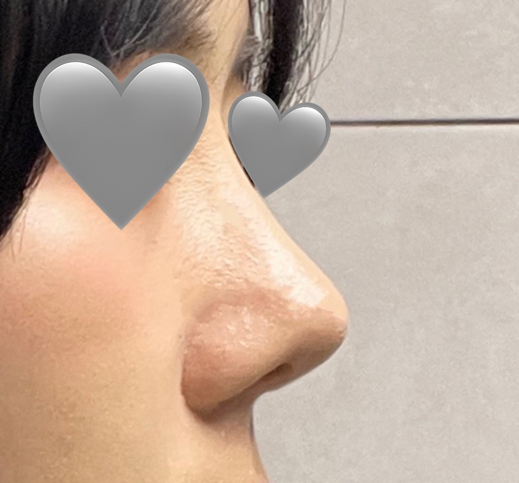 코수술 성공! 주변에서 많이 물어봐요~