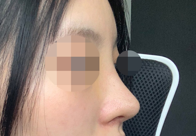 눈재수술 코수술한지 1달이요!