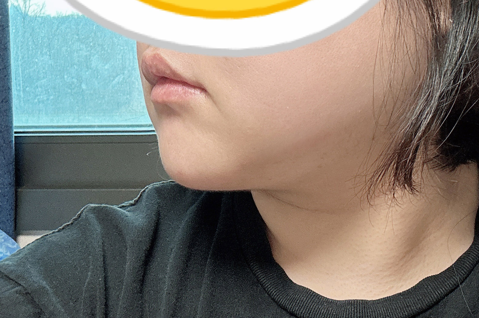 얼굴지방흡입 바이브 강추드려요!