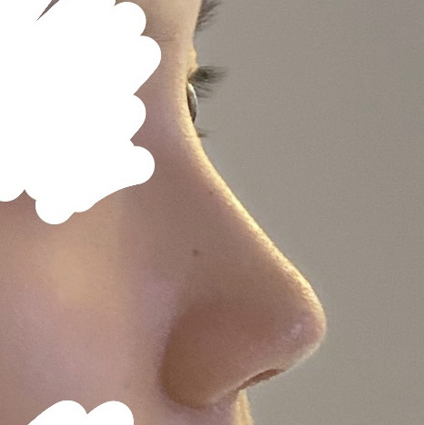 무보형물코수술 맛집 인정해용