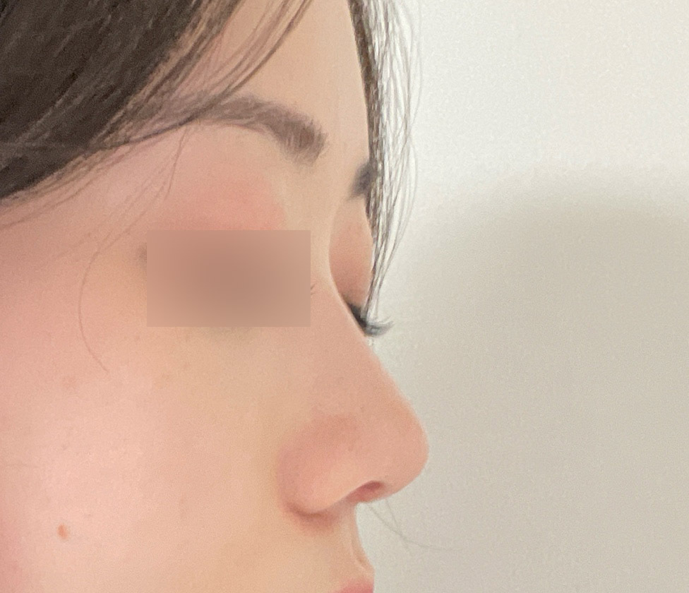 역시 무보형물코성형맛집인듯요!!