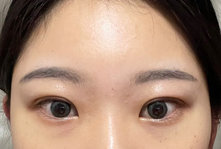 부분절개 쌍수 성공-