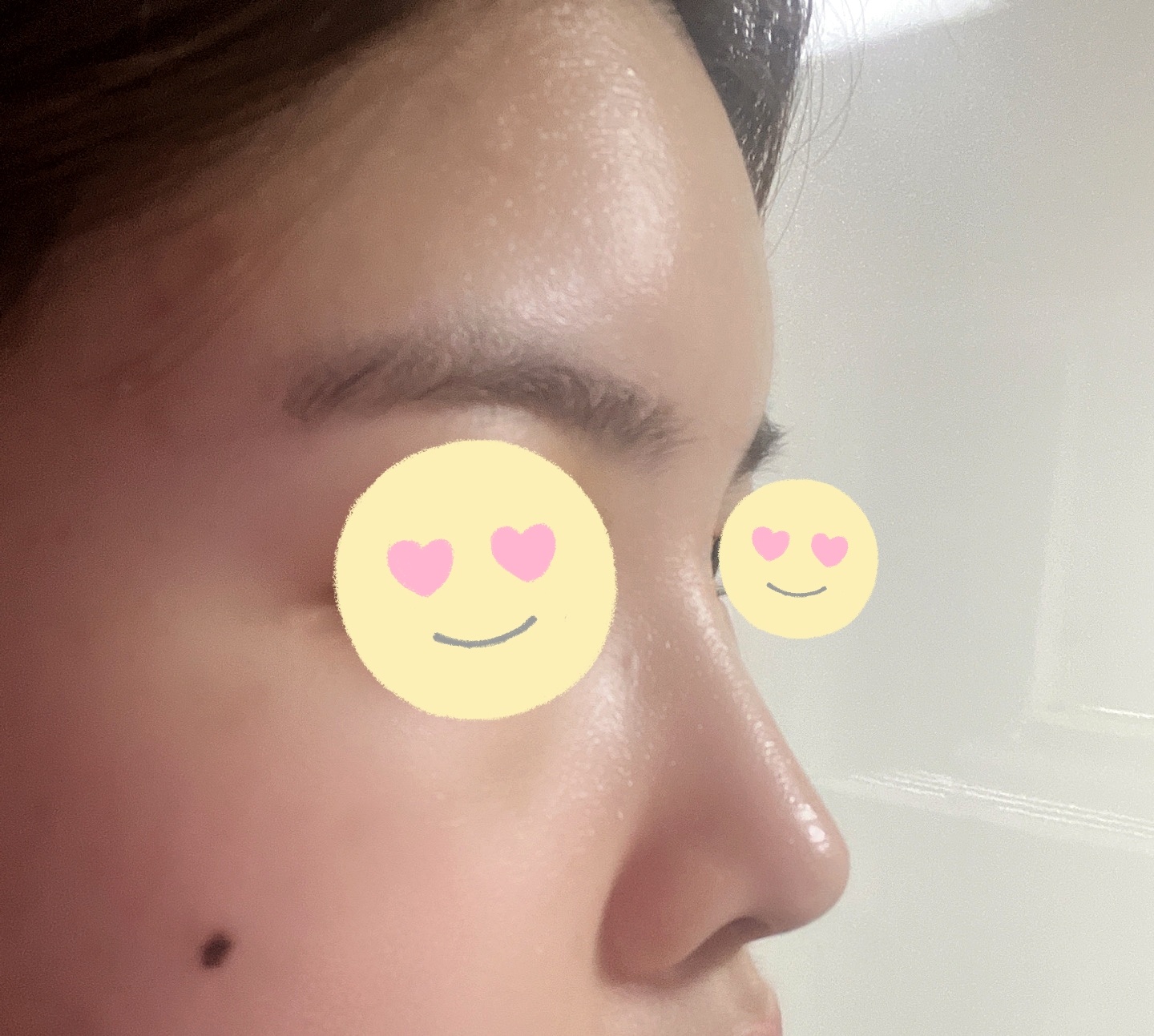 코, 이마지방이식 만족후기~