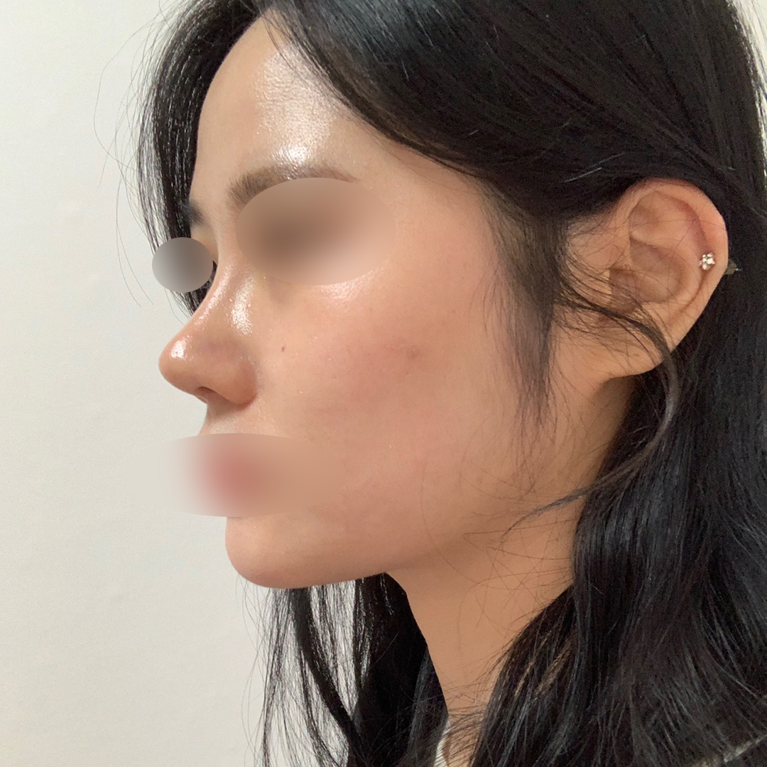 코재수술 딱 원하는대로 됐어요ㅜㅜ