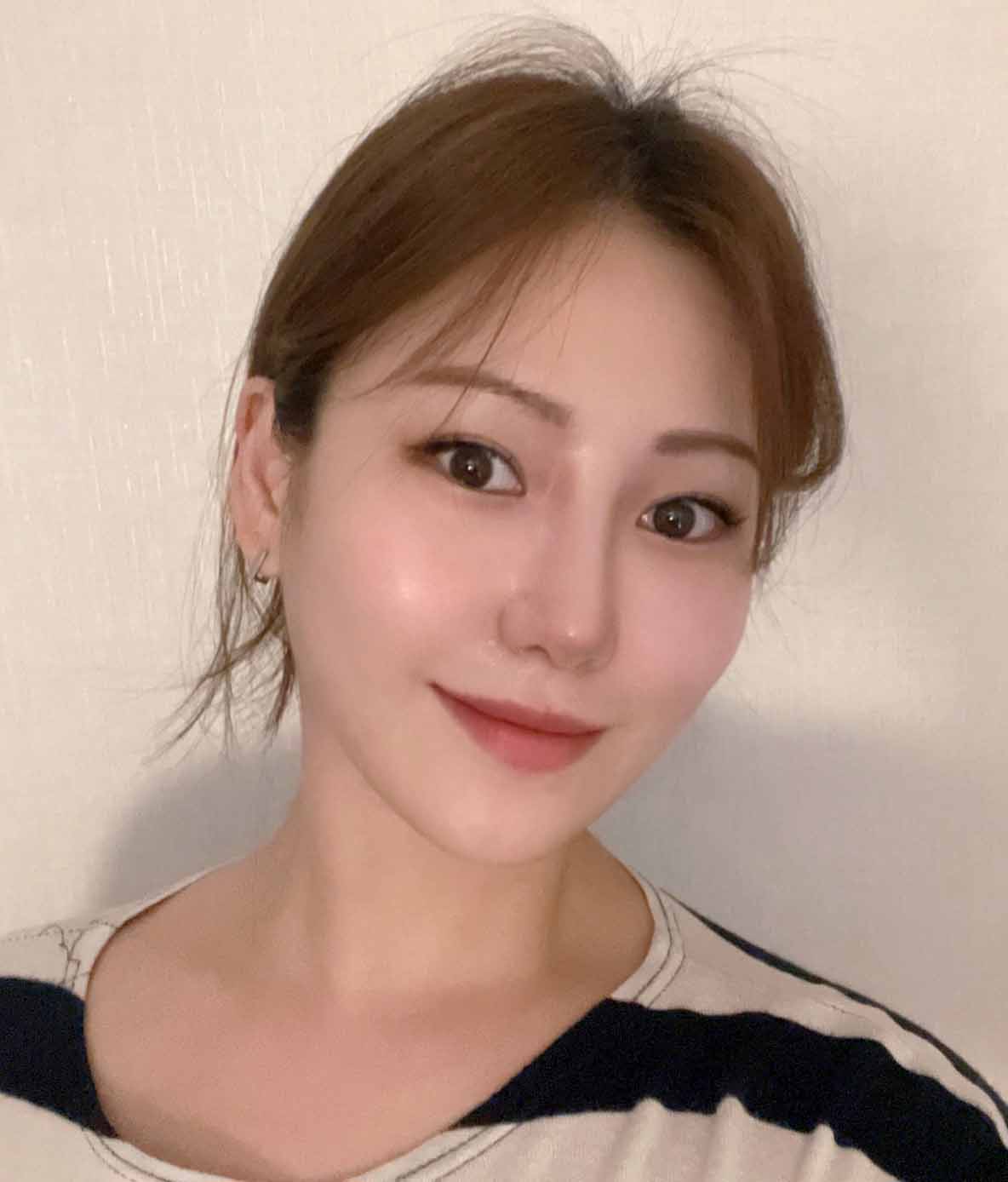 코성형 1개월차 후기