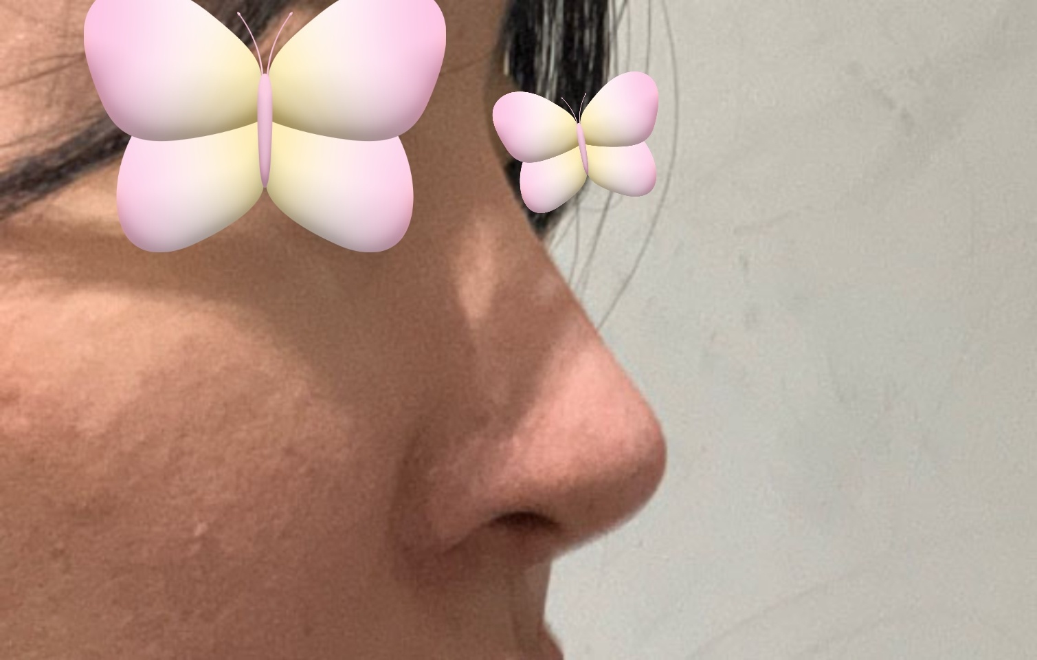 코재수술 1개월차 찐후기올려보아요~~