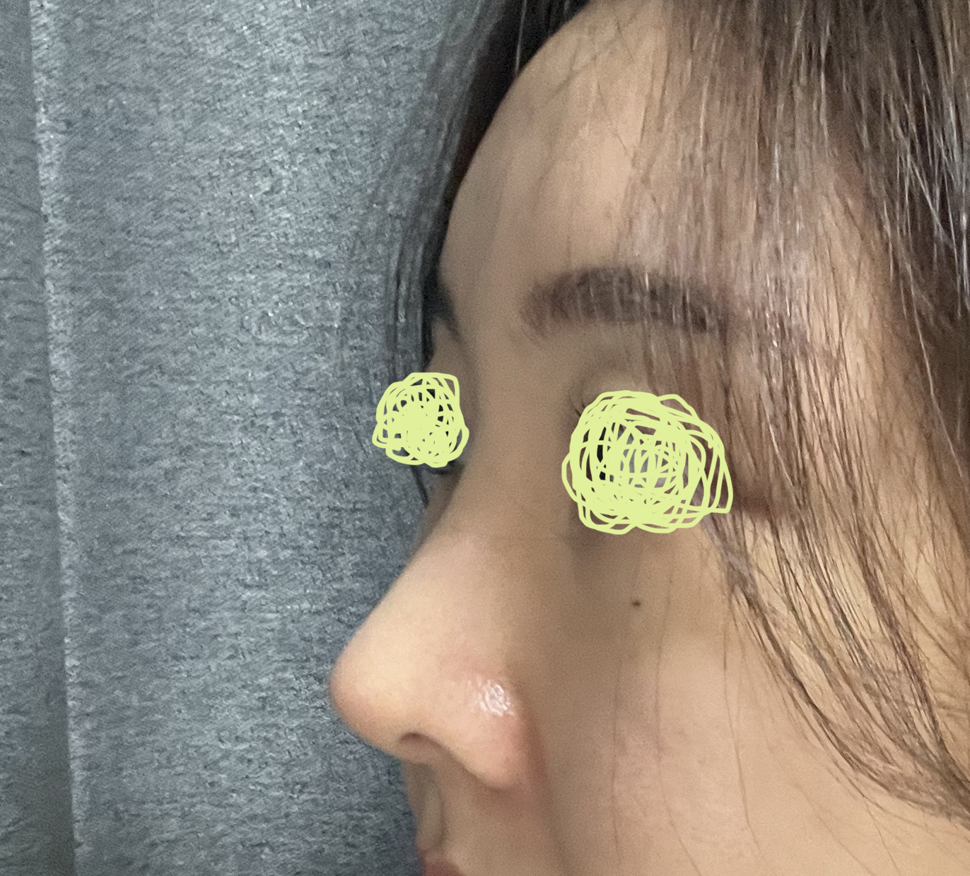 코수술후 아주 만족해요