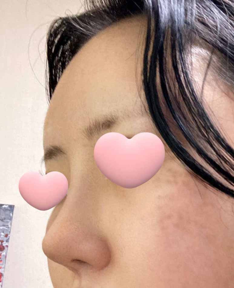 코랑 지방이식 꼭 같이 하세요 ㅋㅋ