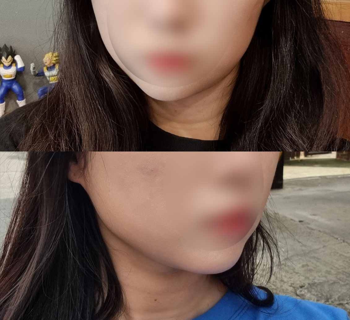 얼지흡 유명한 바이브에서 투턱없앴어요!