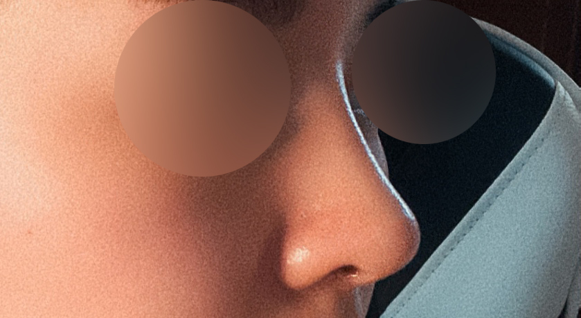 코성형 1개월차 찐 후기:)