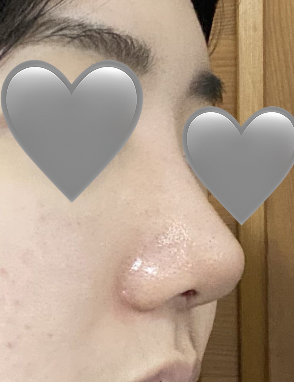 무보형물+코끝재수술+이물질제거