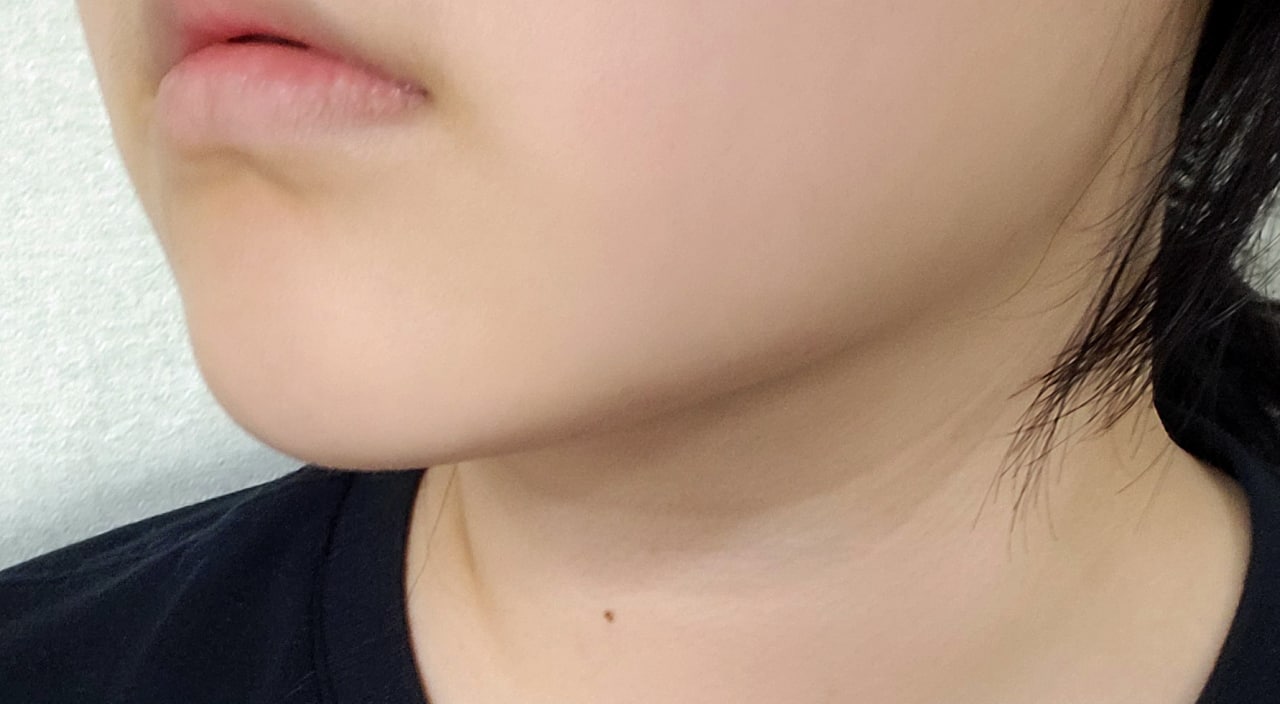 효과 많이 본 수술^^