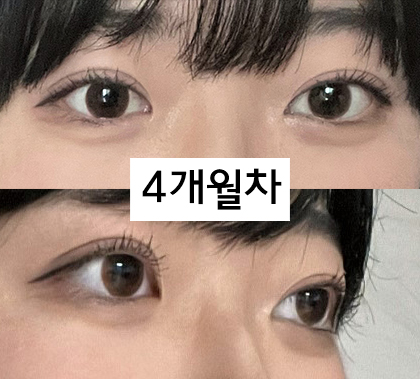 부분눈매교정후기! 처음했는데 만족ㅎㅎ