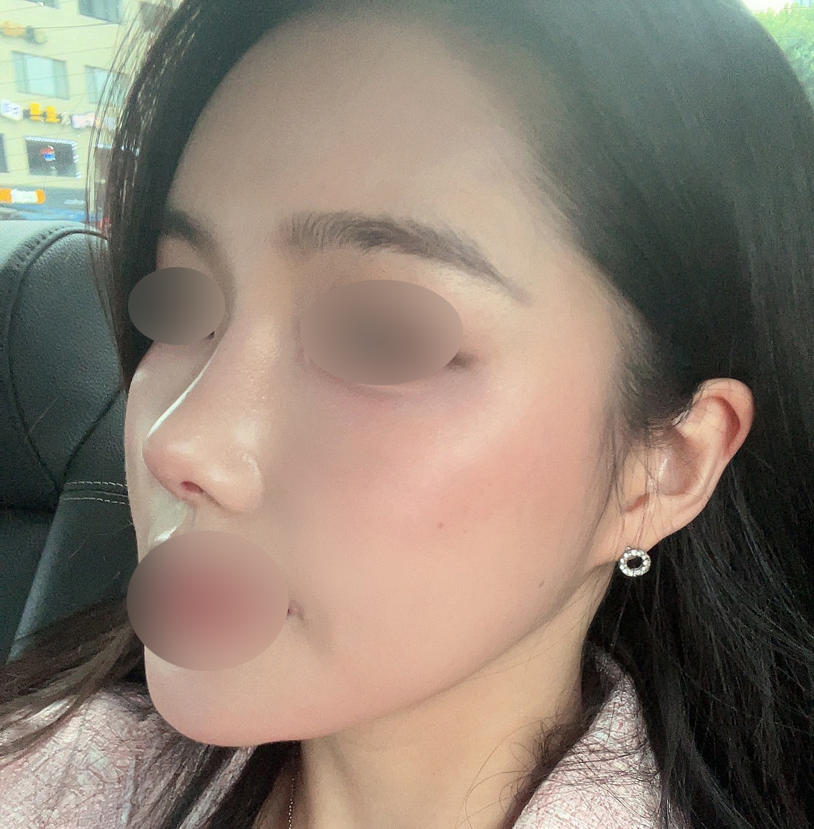 코3번째수술 성공후기^.^