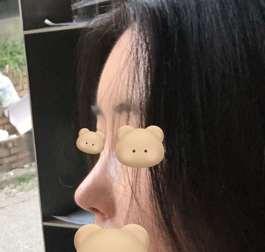 첫코+지방이식 후기!너무 잘돼서 기뻐요!!