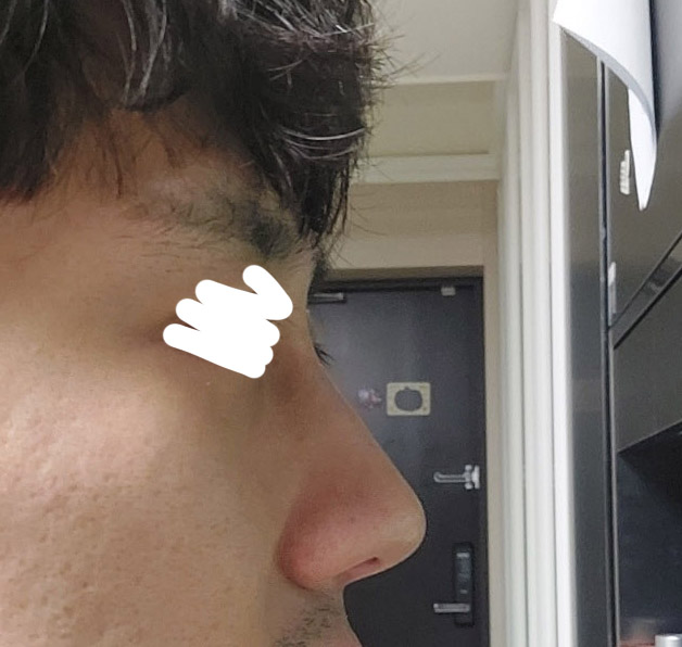 남자눈,코성형 바이브 추천합니다.만족해요!