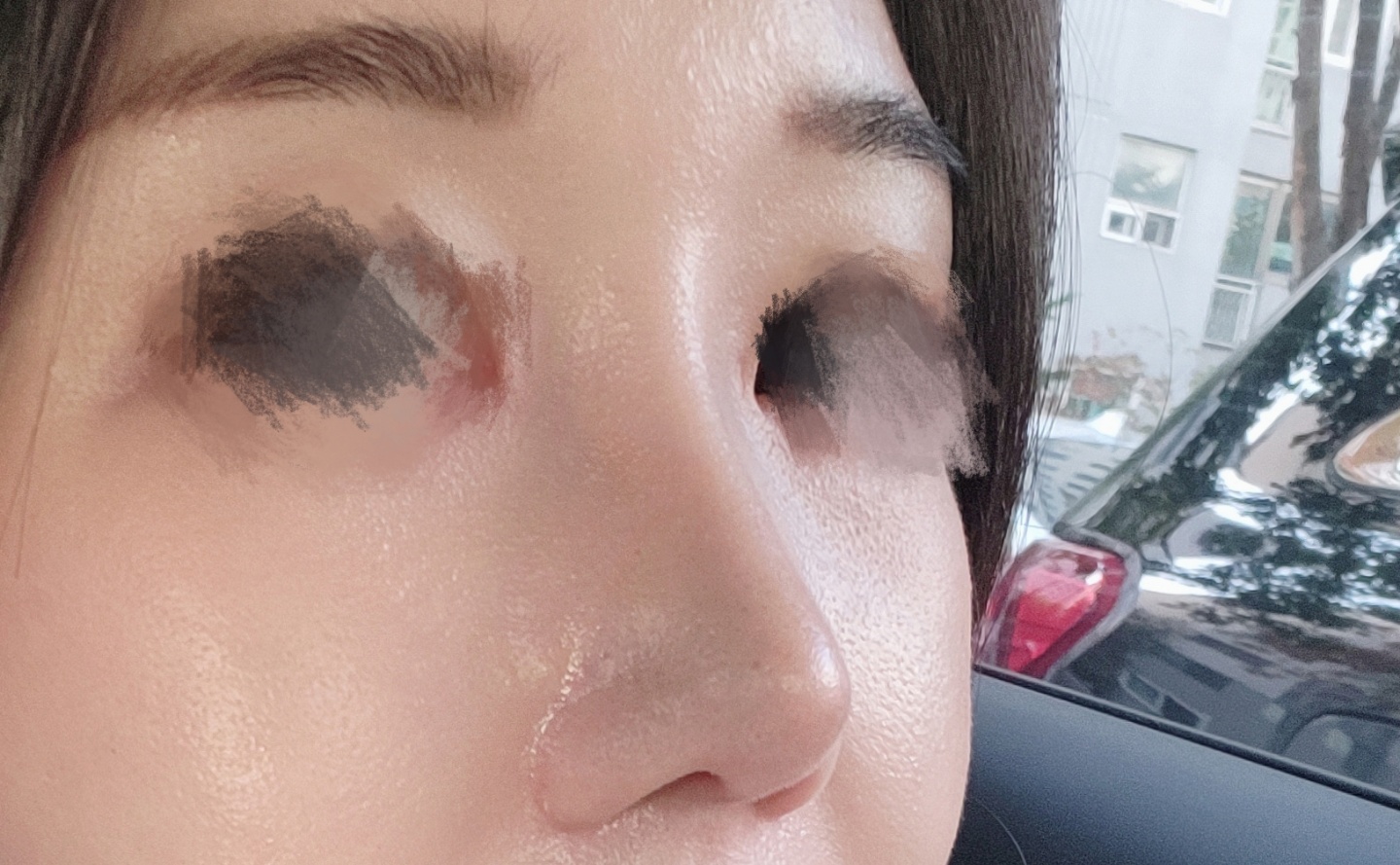 눈코첫수술 대만족이야!