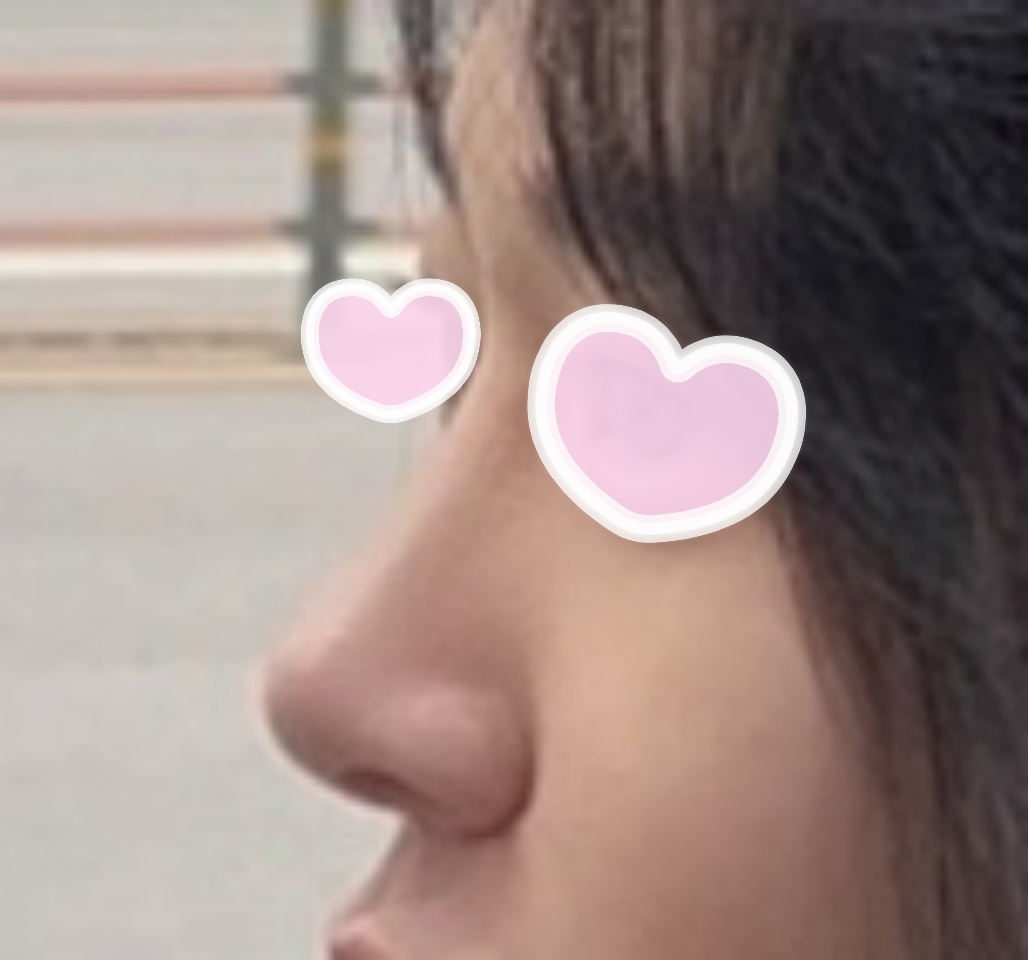 코수술, 얼지흡했어용 너무너무 만족중!!