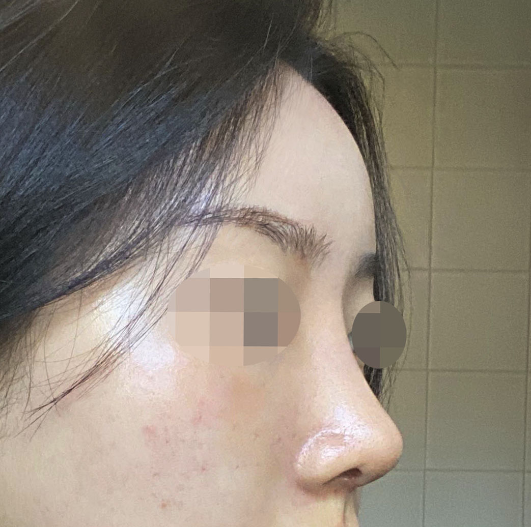 코성형&지방이식 후기+1달차