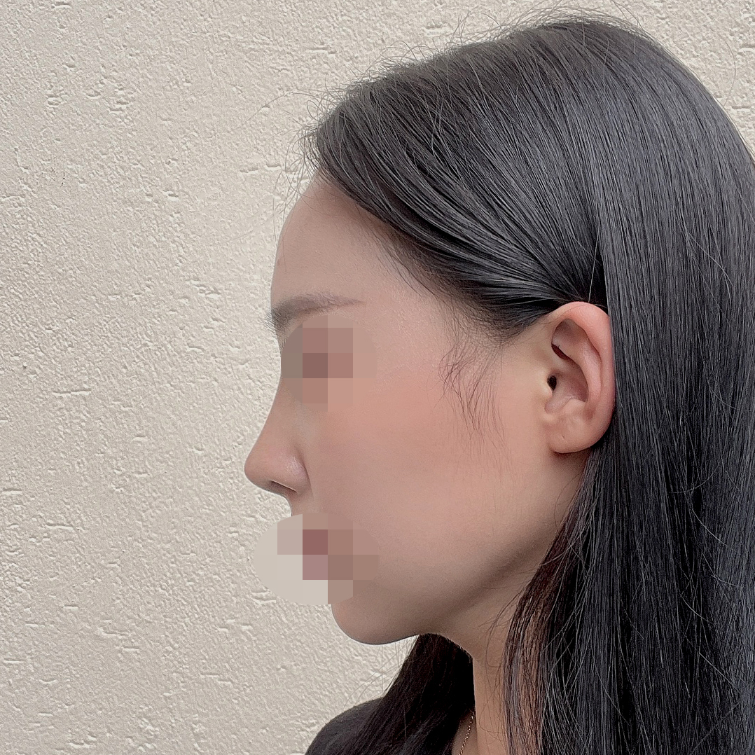 코+이중턱지흡 같이했어요ㅎㅎ