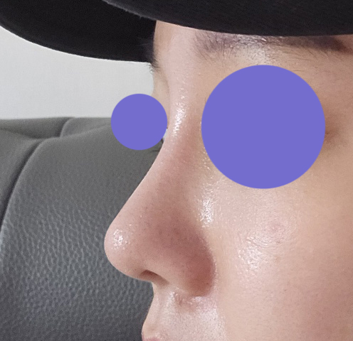 코재수술 받은지 벌써 5개월넘었네용~!