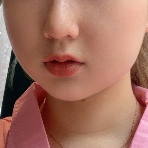 이중턱 고민하지말고 얼굴지흡하세요