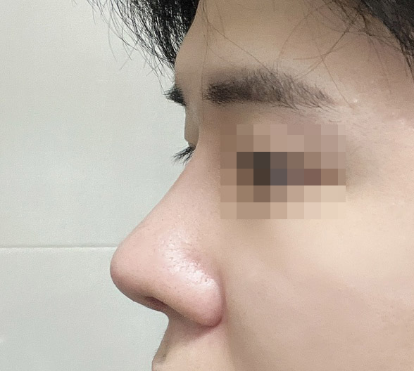 남자코재수술후기