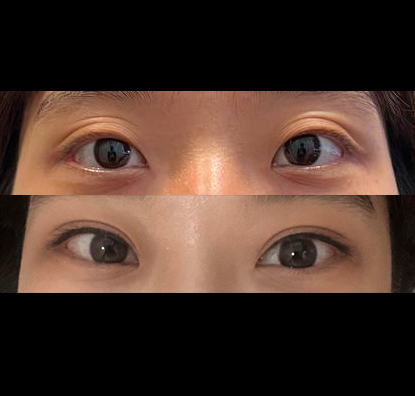 겹주름진 눈, 졸린 눈이 초롱초롱~