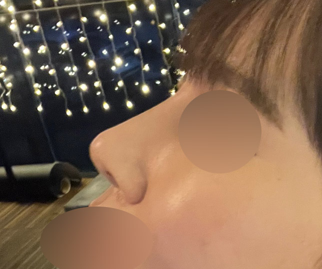 코&얼굴지방흡입 4갤차