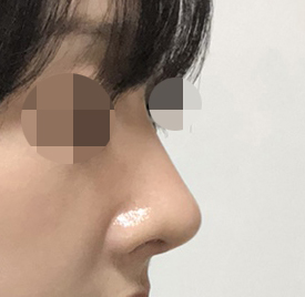 바이브에서 코수술! 정말 만족하며 지내요:)