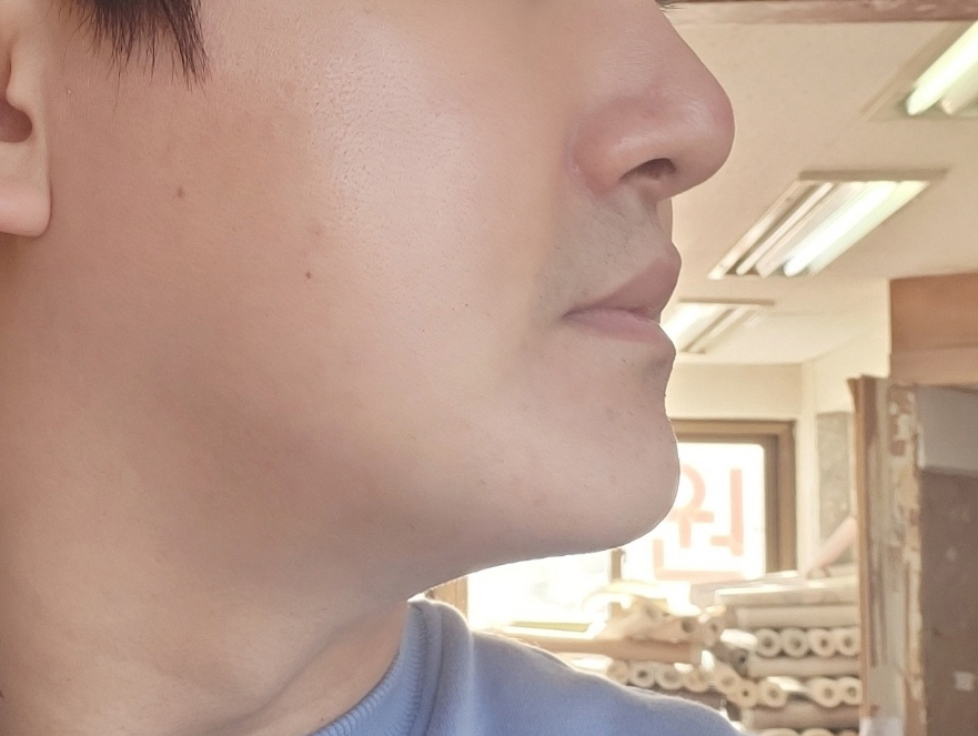 이중턱지방흡입 마음에 듭니다!