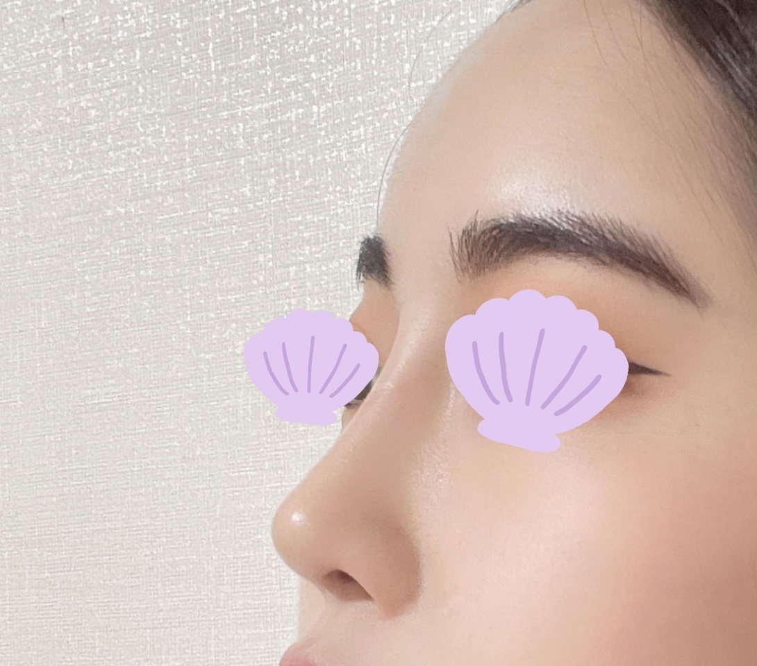 짧은코, 작은코 이별했어용