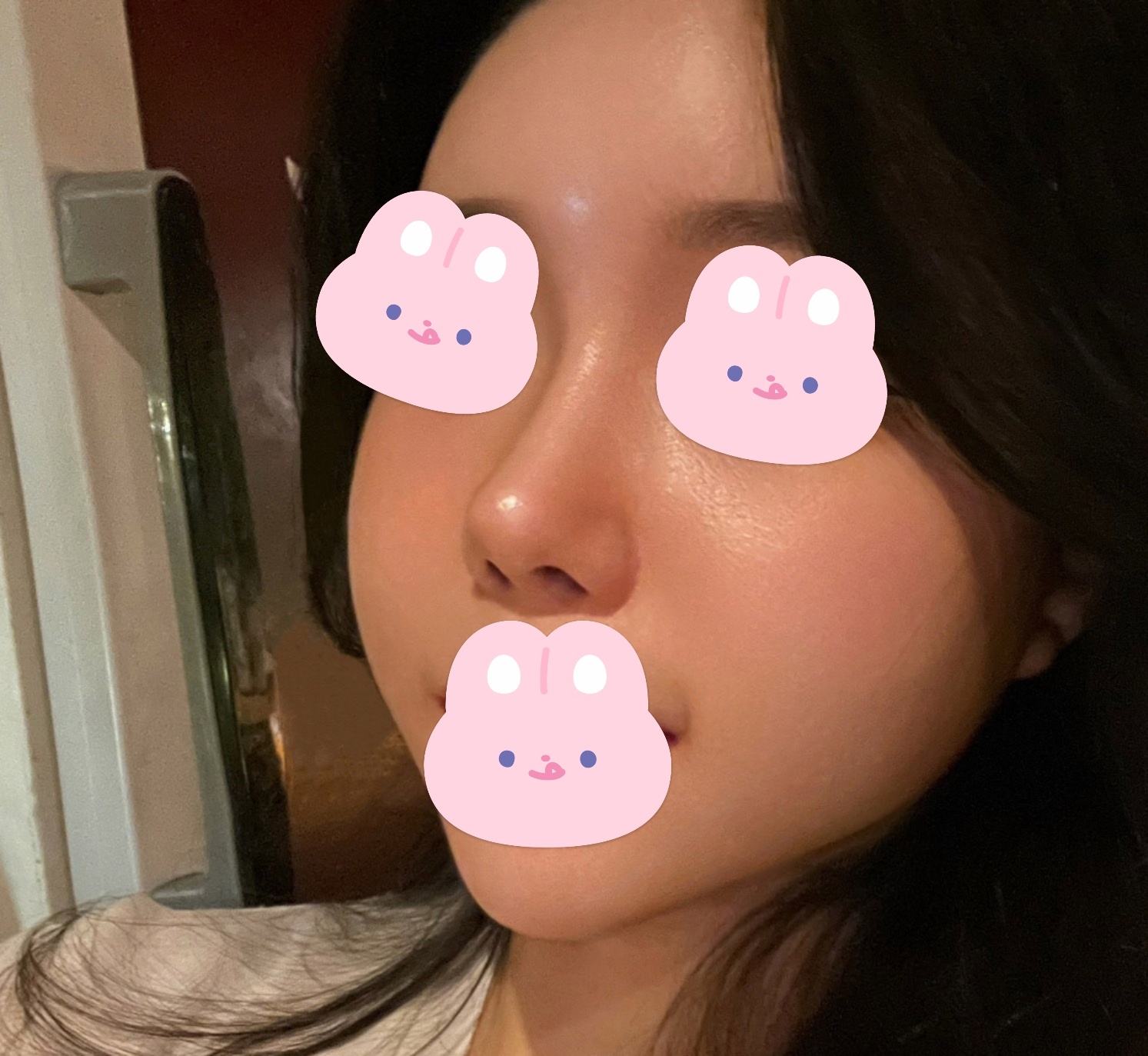 코재수술이랑 얼굴지방흡입 잘됐죠?