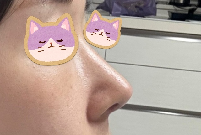 보형물없이 코수술한지 3주차:)