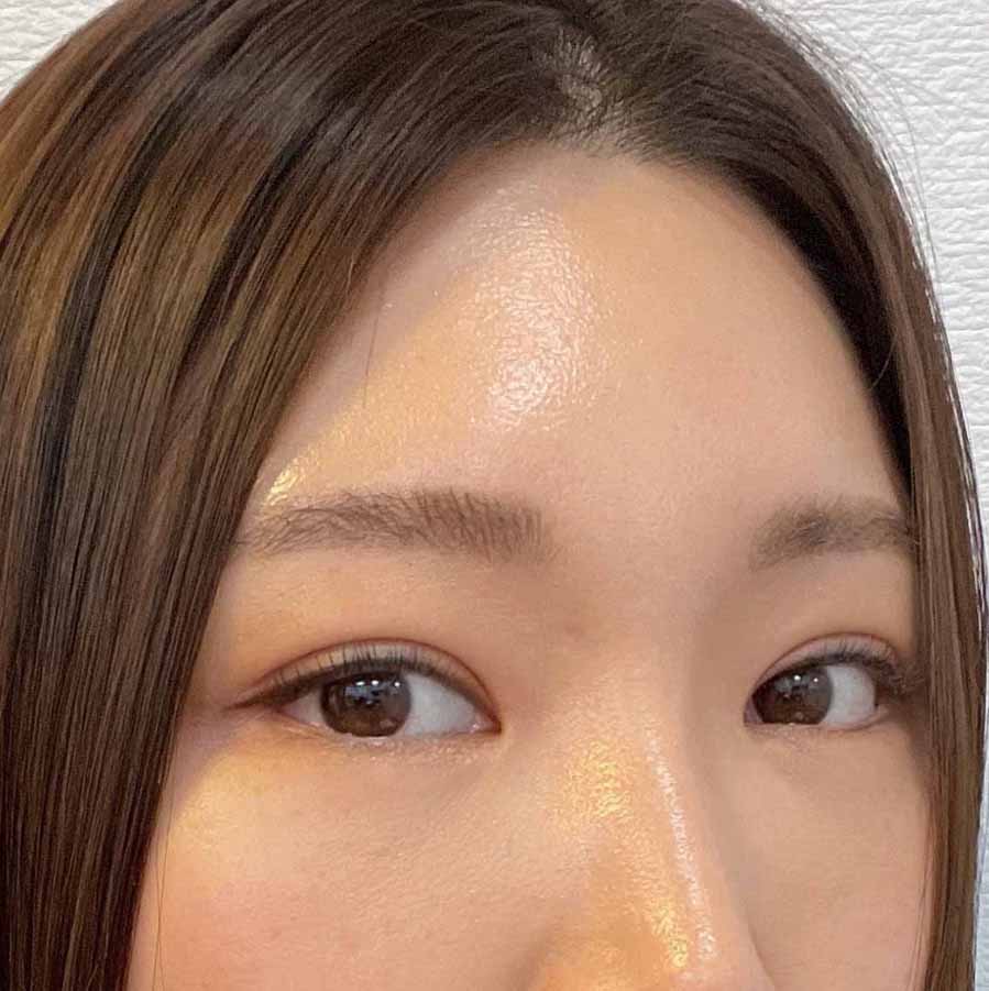 내시경이마거상, 쌍꺼풀 재수술 3개월차