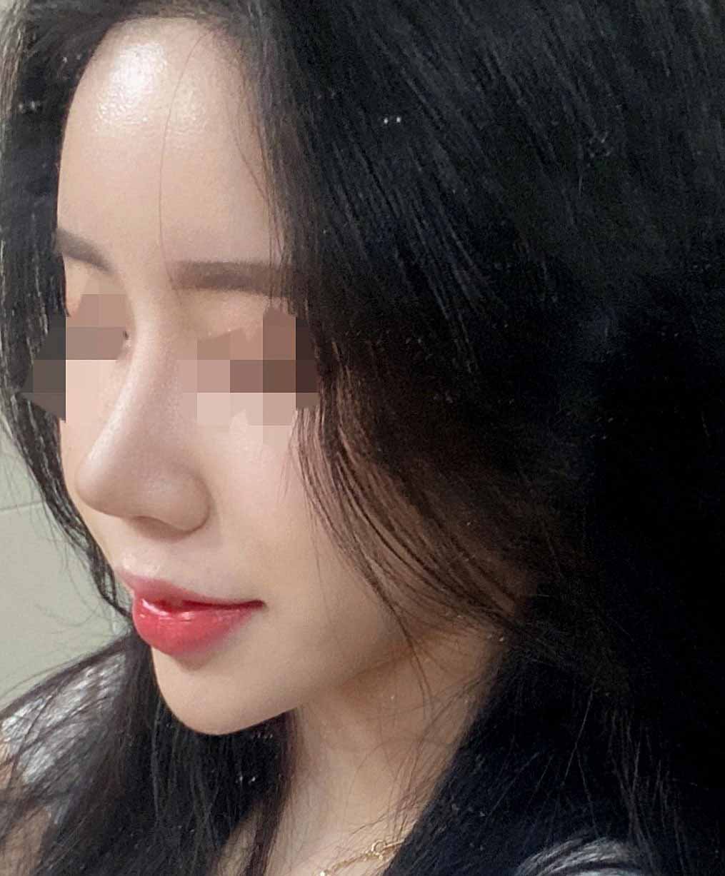 코성형한지 6개월 됐어여~