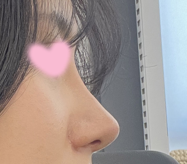 복코수술한지 4개월차~_~