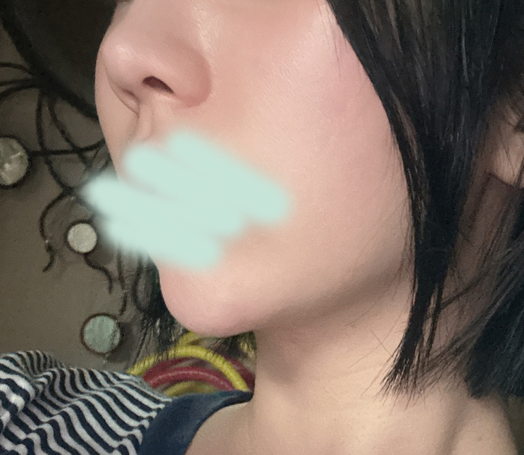 지방흡입 바이브에서 잘한거같아요