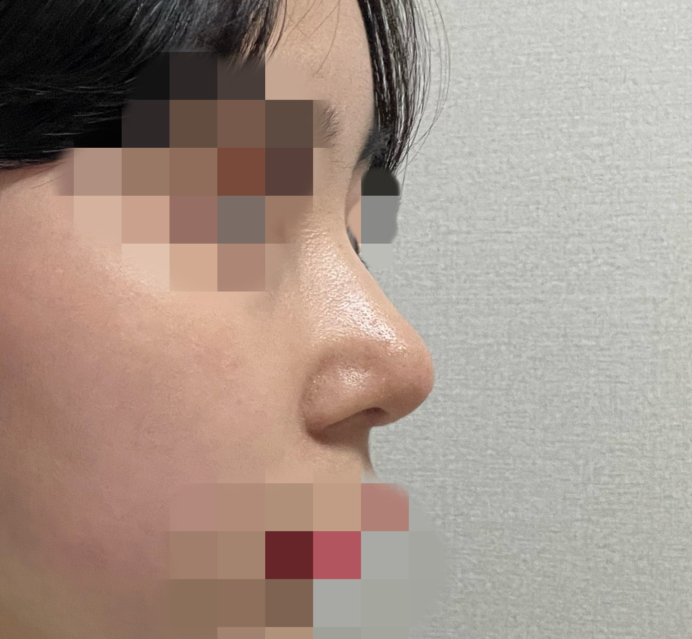 매부리코성형 잘된 후기