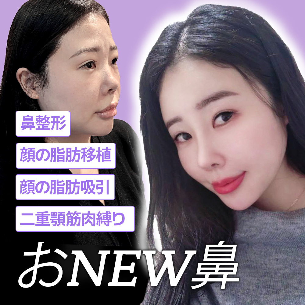 【韓国整形】鼻フルしてきました。カウセからダウンタイムまで大公開