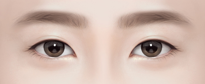 쌍꺼풀이 풀린 경우