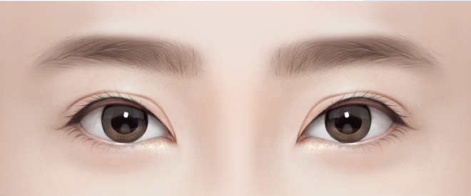 속눈썹이 들린 경우