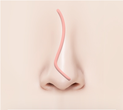 보형물이 비쳐보이는 경우