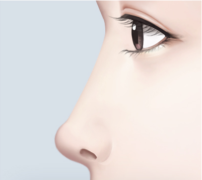 코끝이 뭉툭이 올라간 경우